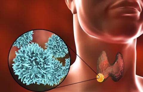 云南中西醫結合醫院醫生 甲狀腺 病 了不要慌,做好這4點,助 甲 健康