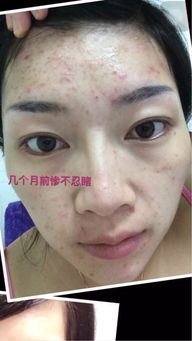 夏至長痘如何選擇祛痘產品