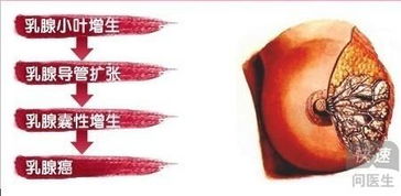 乳腺小葉增生吃什么藥最好