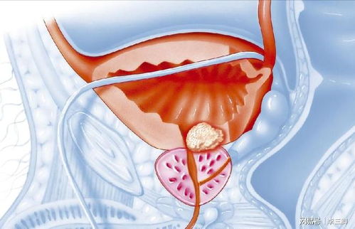 前列腺增生 病因、癥狀與應對策略